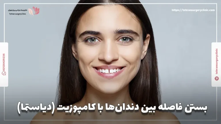 بستن فاصله بین دندان‌ها با کامپوزیت (دیاستما)