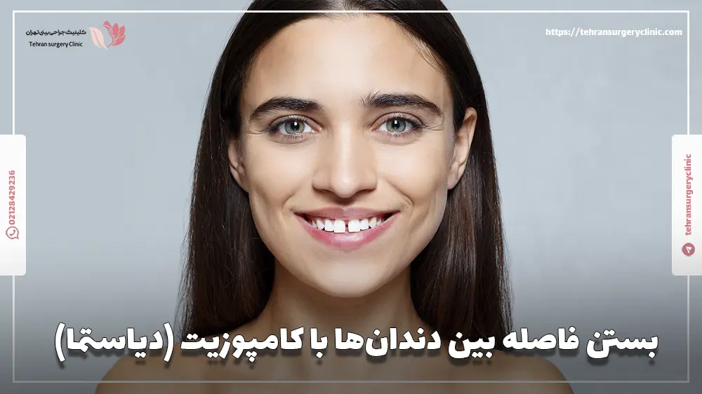 بستن فاصله بین دندان‌ها با کامپوزیت (دیاستما)