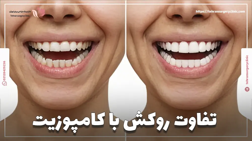 تفاوت روکش با کامپوزیت
