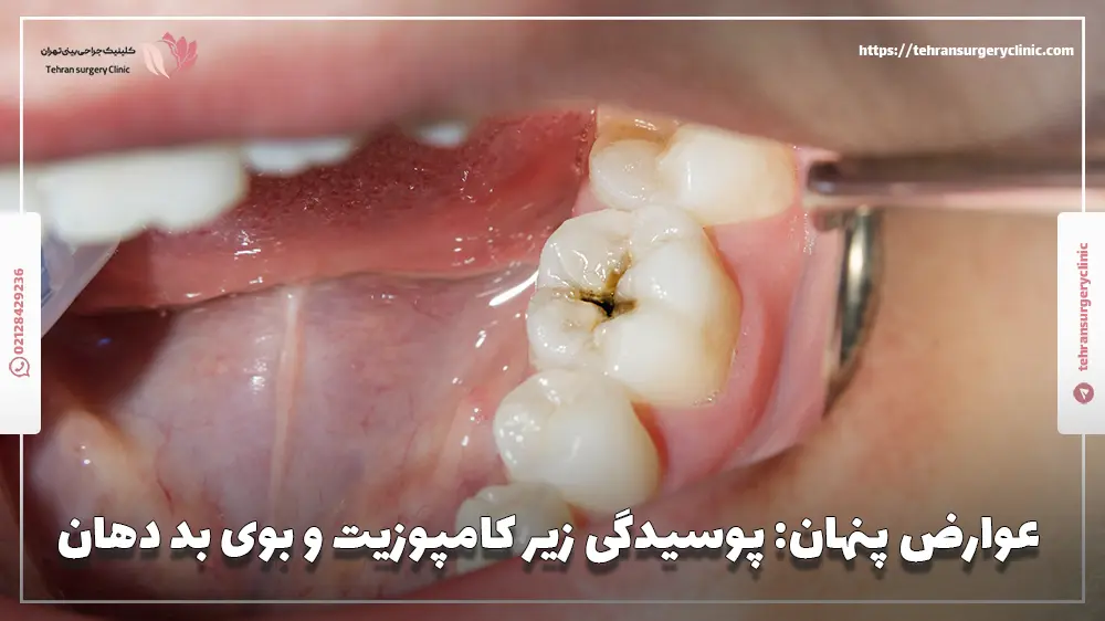عوارض پنهان پوسیدگی زیر کامپوزیت و بوی بد دهان