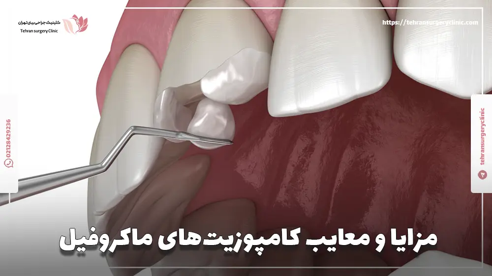 مزایا و معایب کامپوزیت‌های ماکروفیل