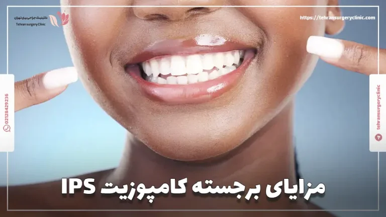 کامپوزیت آی پی اس: مزایا و معایب کامپوزیت IPS