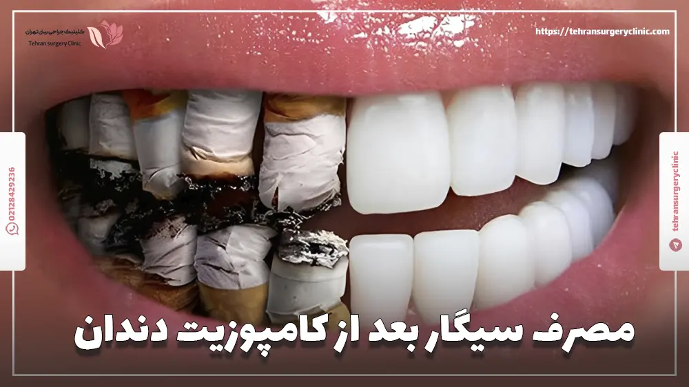 مصرف سیگار بعد از کامپوزیت دندان