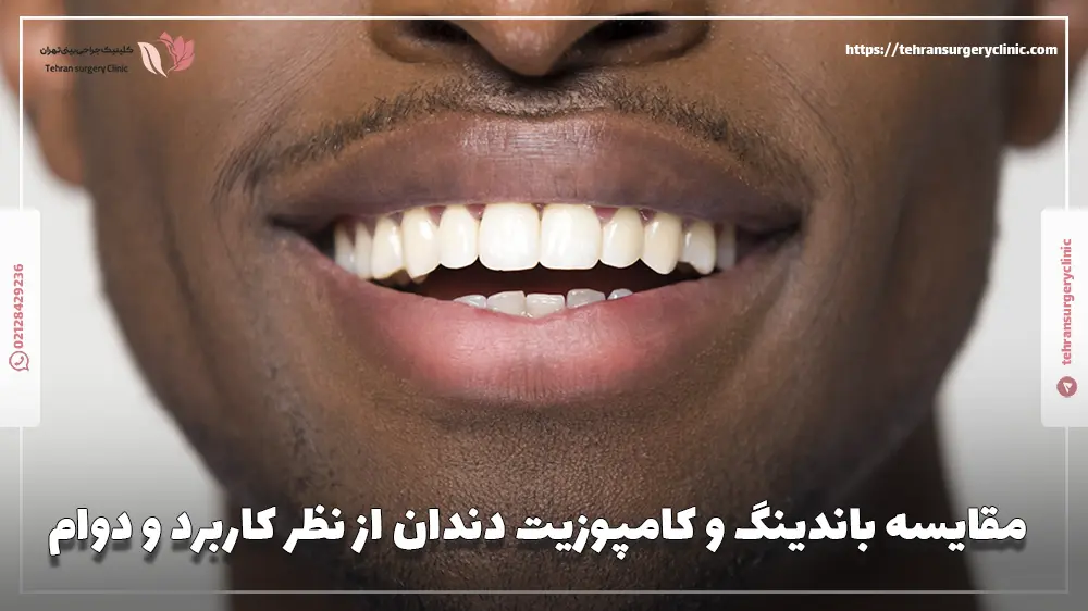 مقایسه باندینگ و کامپوزیت دندان از نظر کاربرد و دوام