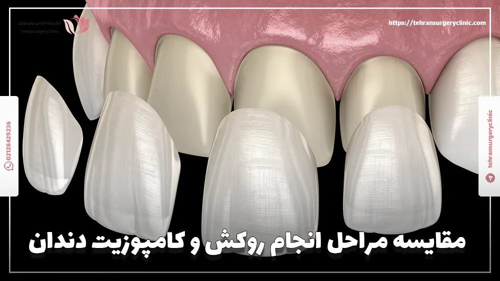 مقایسه مراحل انجام روکش و کامپوزیت دندان