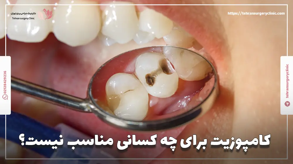 کامپوزیت برای چه کسانی مناسب نیست؟