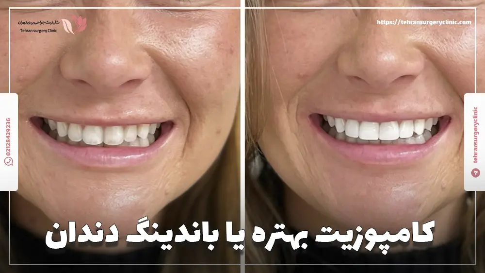 کامپوزیت بهتره یا باندینگ دندان