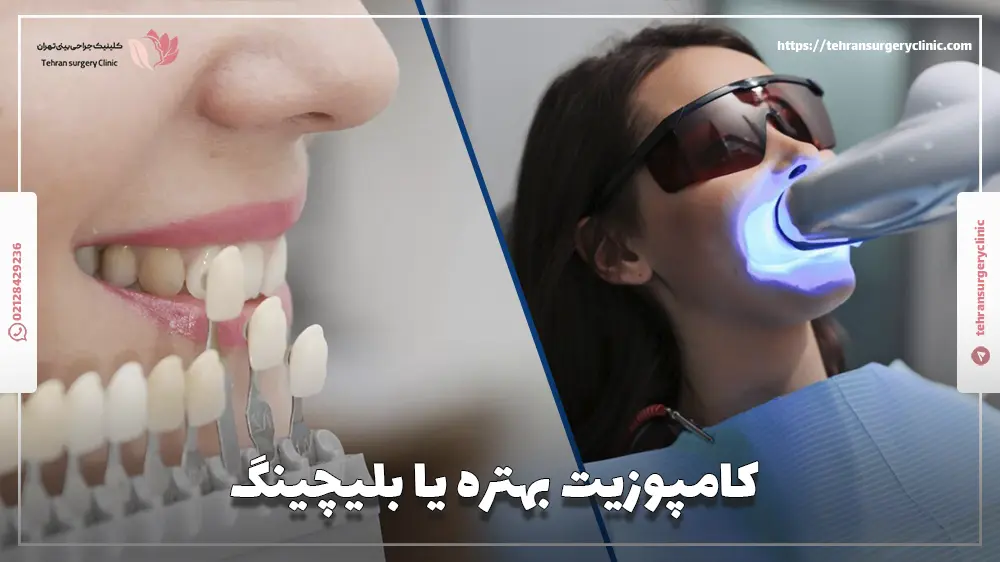 کامپوزیت بهتره یا بلیچینگ