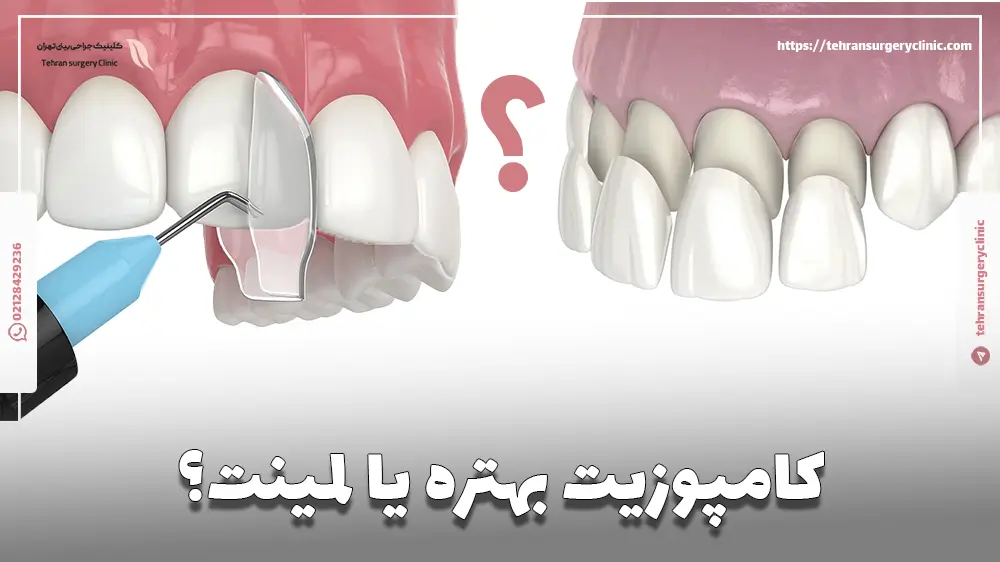 کامپوزیت بهتره یا لمینت؟