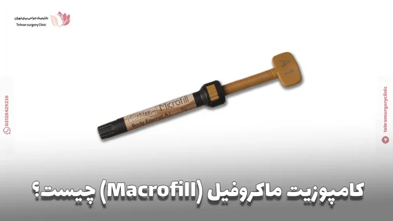 کامپوزیت ماکروفیل (Macrofill) چیست؟ مزایا و معایب ماکروفیل