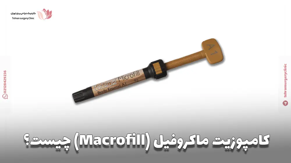 کامپوزیت ماکروفیل (Macrofill) چیست؟