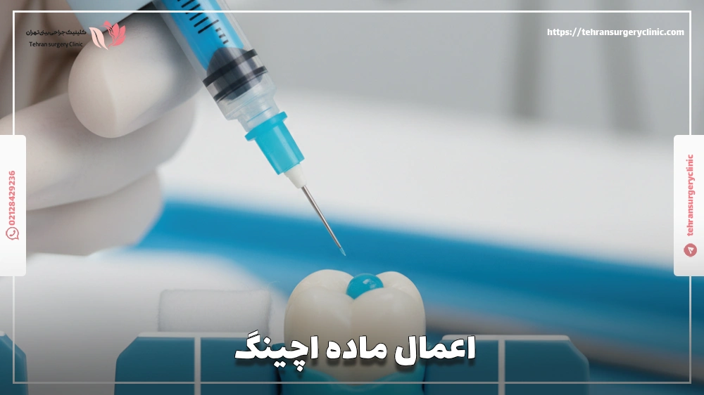 اعمال ماده اچینگ