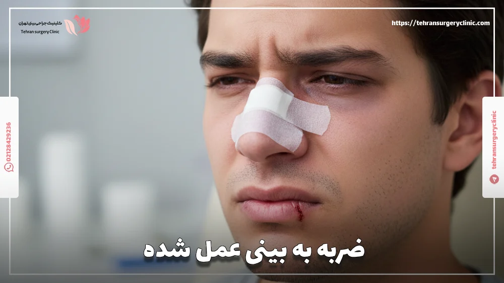 ضربه به بینی عمل شده - ضربه به دماغ عمل شده