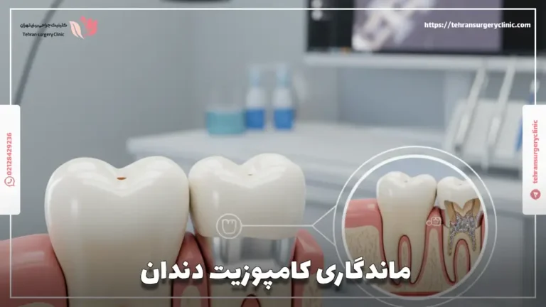 ماندگاری کامپوزیت دندان: طول عمر کامپوزیت دندان چقدر است؟