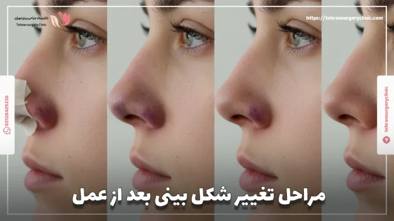 مراحل تغییر شکل بینی بعد از عمل: فرم نهایی دماغ بعد جراحی چگونه شکل می‌گیرید؟