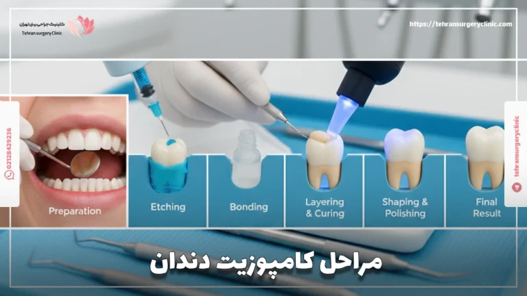 مراحل کامپوزیت دندان مرحله‌به‌مرحله