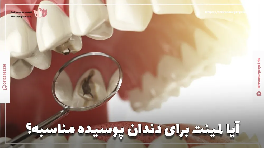 آیا لمینت برای دندان پوسیده مناسبه؟