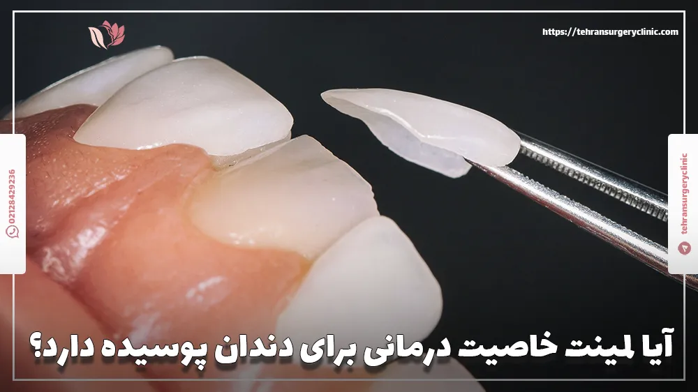 آیا لمینت خاصیت درمانی برای دندان پوسیده دارد؟