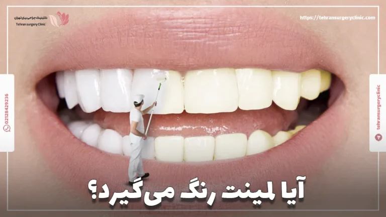 آیا لمینت رنگ می‌گیرد؟ علت تغییر رنگ لمینت دندان