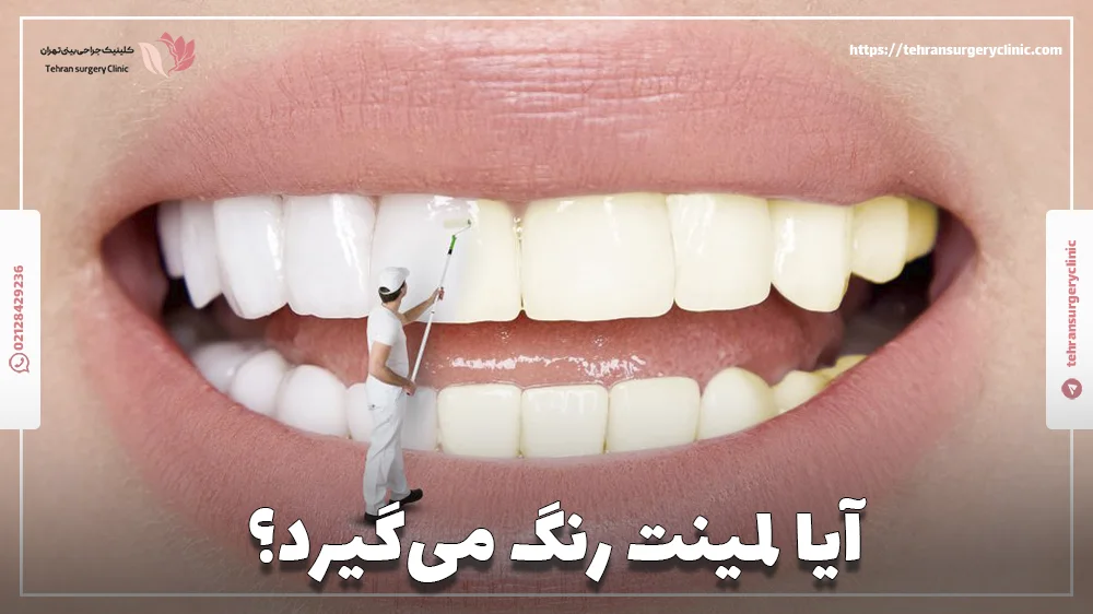 آیا لمینت رنگ می‌گیرد؟