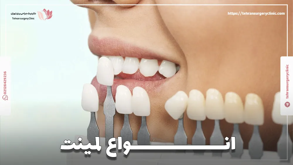 انواع لمینت