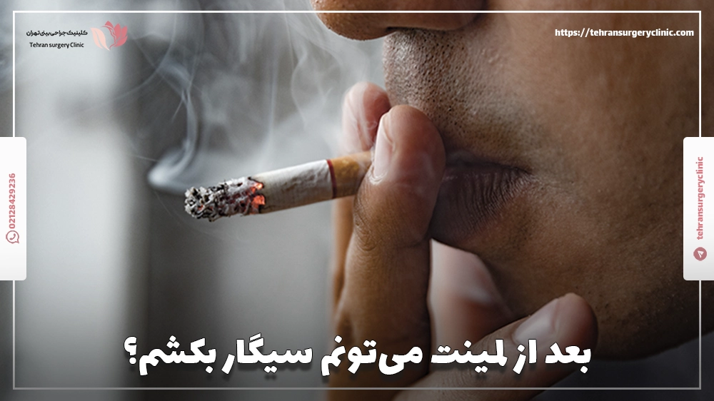 بعد از لمینت می‌تونم سیگار بکشم؟
