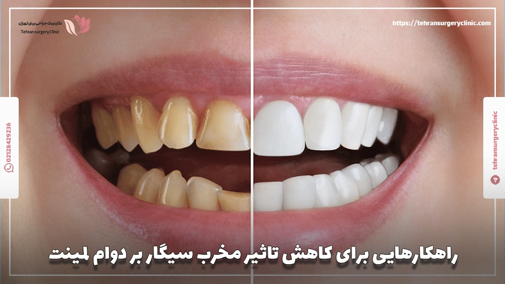 راهکارهایی برای کاهش تاثیر مخرب سیگار بر دوام لمینت
