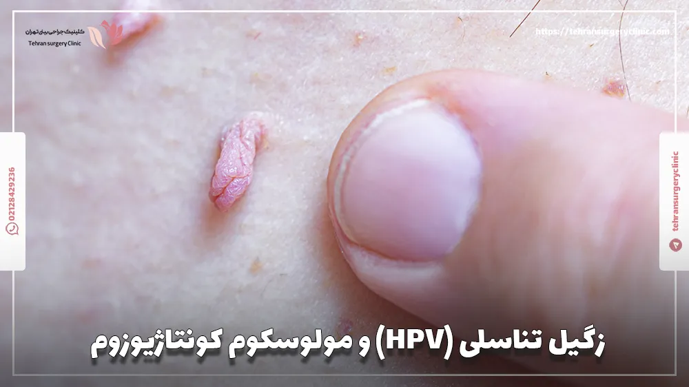 زگیل تناسلی (HPV) و مولوسکوم کونتاژیوزوم
