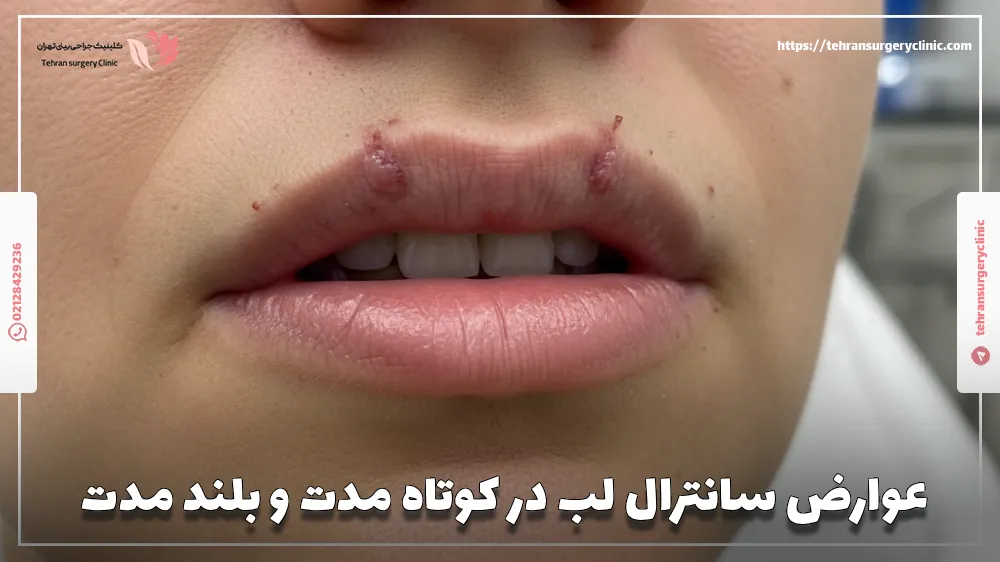 عوارض سانترال لب