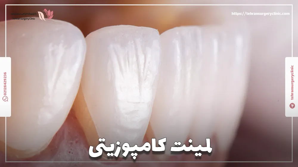 لمینت کامپوزیتی