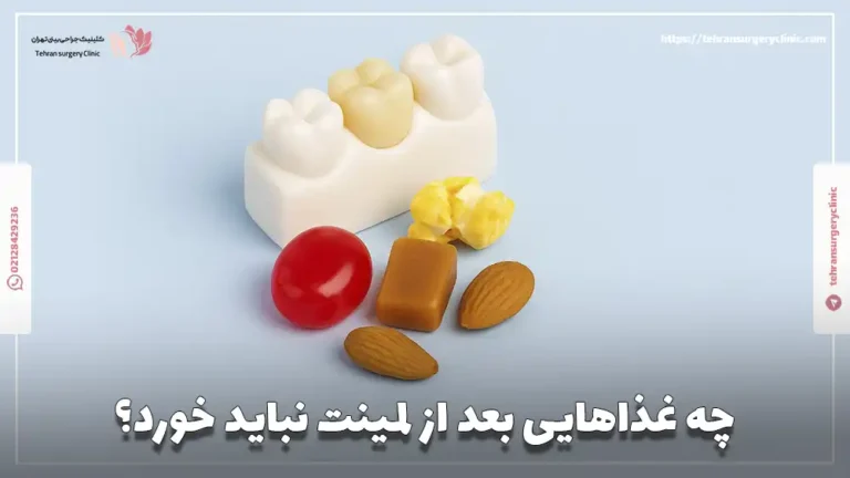 چه غذاهایی بعد از لمینت نباید خورد؟