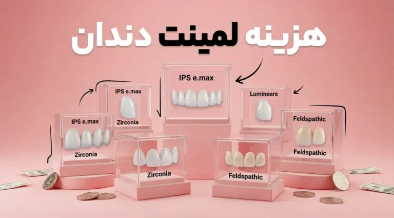 هزینه لمینت دندان | قيمت هر واحد لمينت