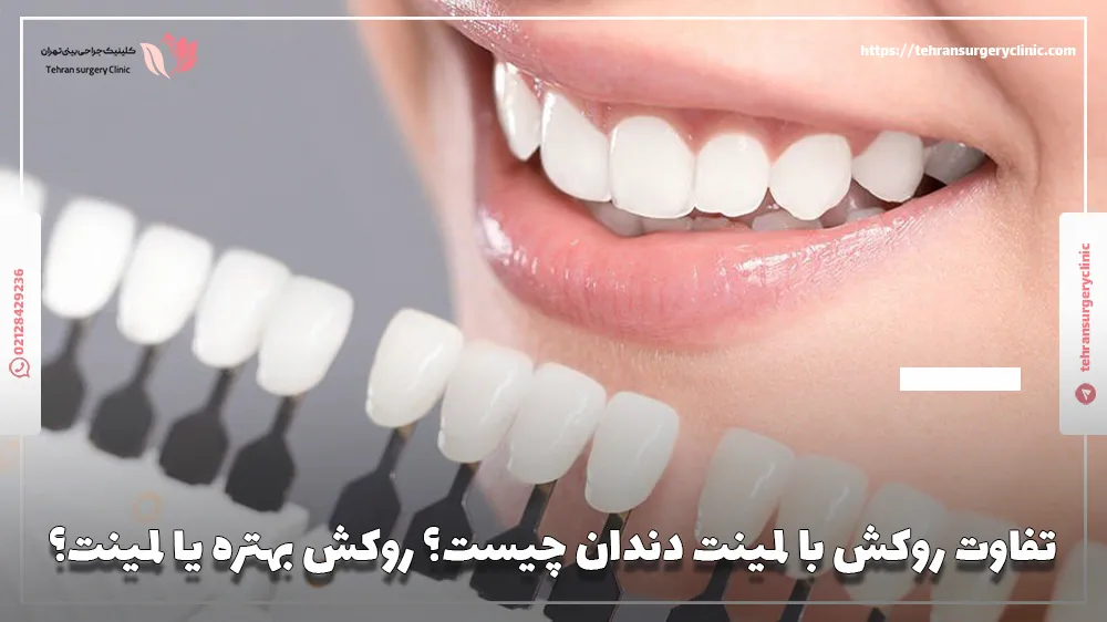 تفاوت روکش با لمینت دندان چیست؟ روکش بهتره یا لمینت؟