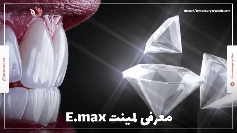 معرفی لمینت E.max: مزایا، معایب و هزینه لمینت ای مکس