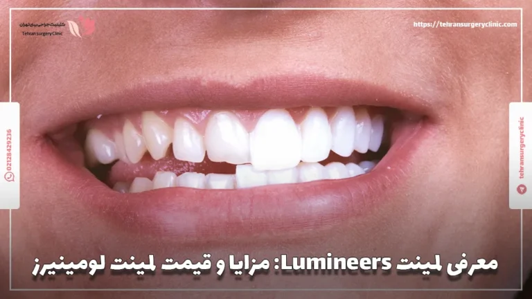 معرفی لمینت Lumineers: مزایا و قیمت لمینت لومینیرز