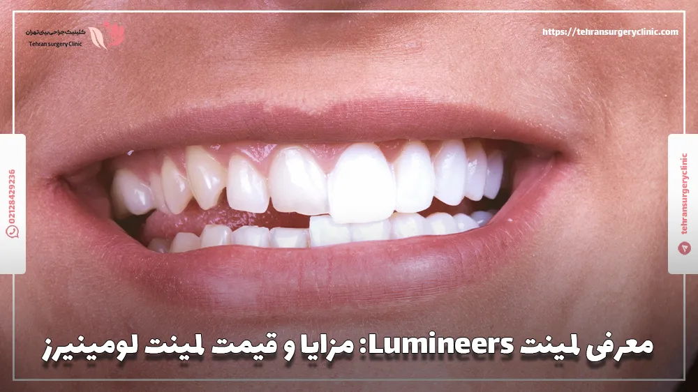 لمینت Lumineers