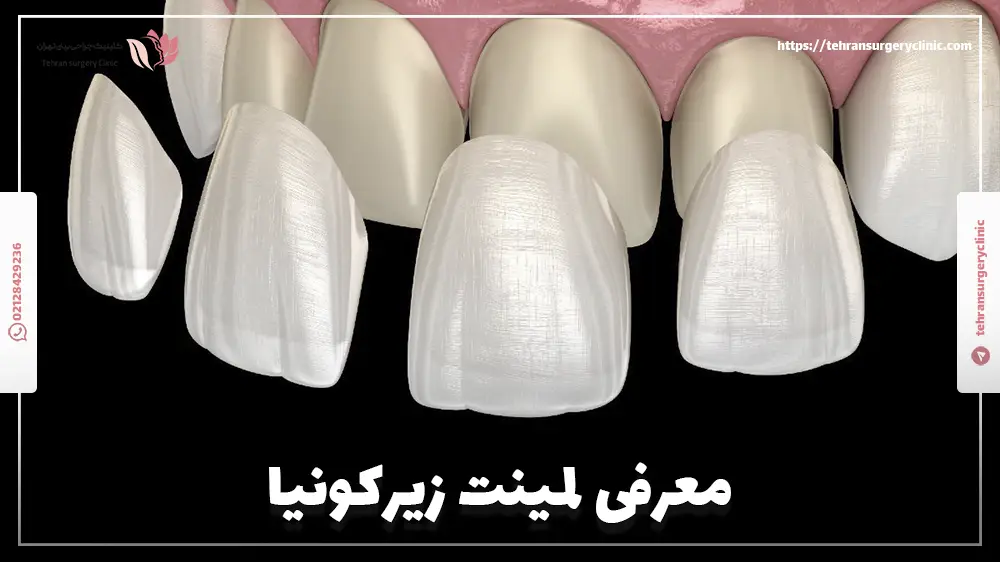 معرفی لمینت زیرکونیا