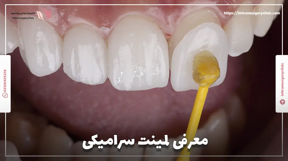 معرفی لمینت سرامیکی