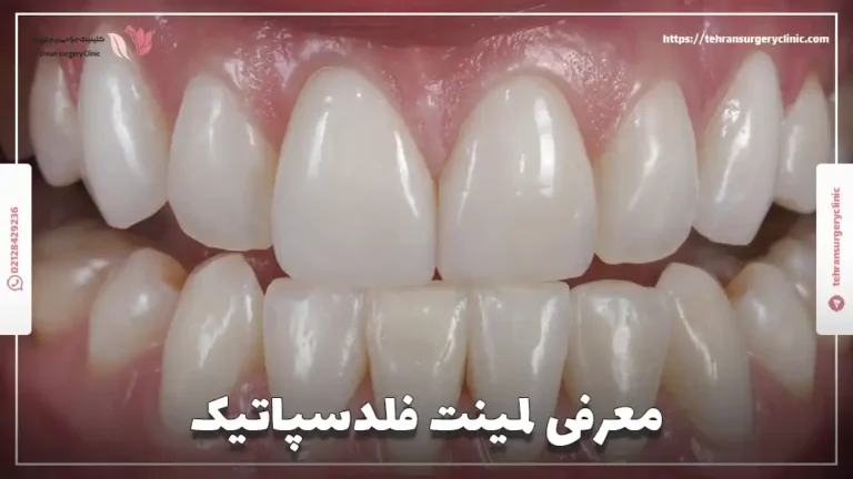 معرفی لمینت فلدسپاتیک: مزایا، معایب و هزینه فلدسپاتیک