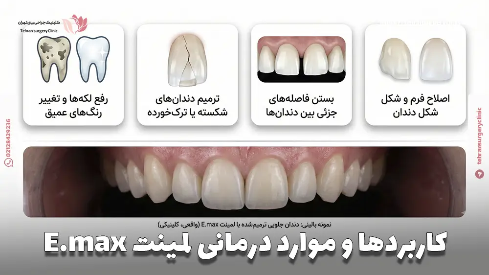 کاربردها و موارد درمانی لمینت E.max